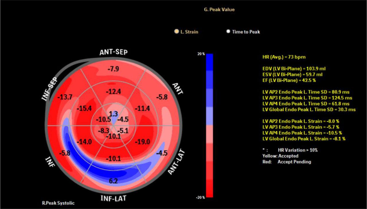 Strain echocardiography performed in 2025 revealed moderate left ventricular systolic dysfunction (EF: 42.5%; GLS: −8%), with more pronounced impairment in the inferior wall.