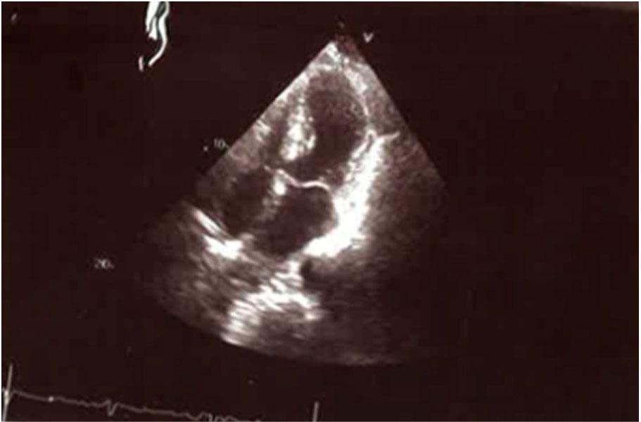 Transthoracic echocardiographic apical four-chamber view in systole showing ballooning of the apical segments.