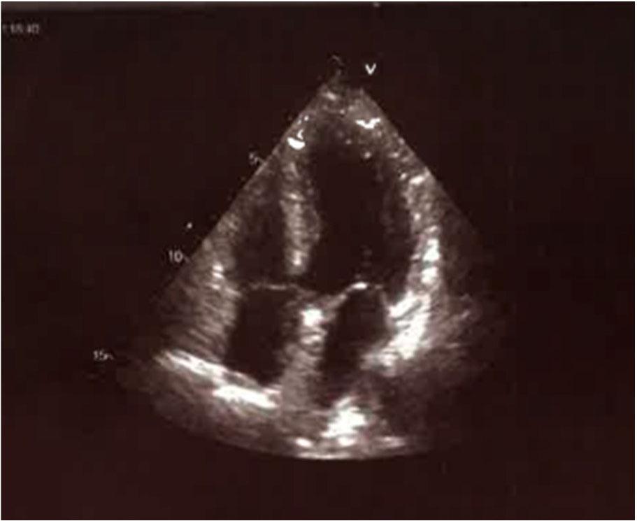 Transthoracic echocardiographic apical four-chamber view in systole showing ballooning of the apical segments 3 days later