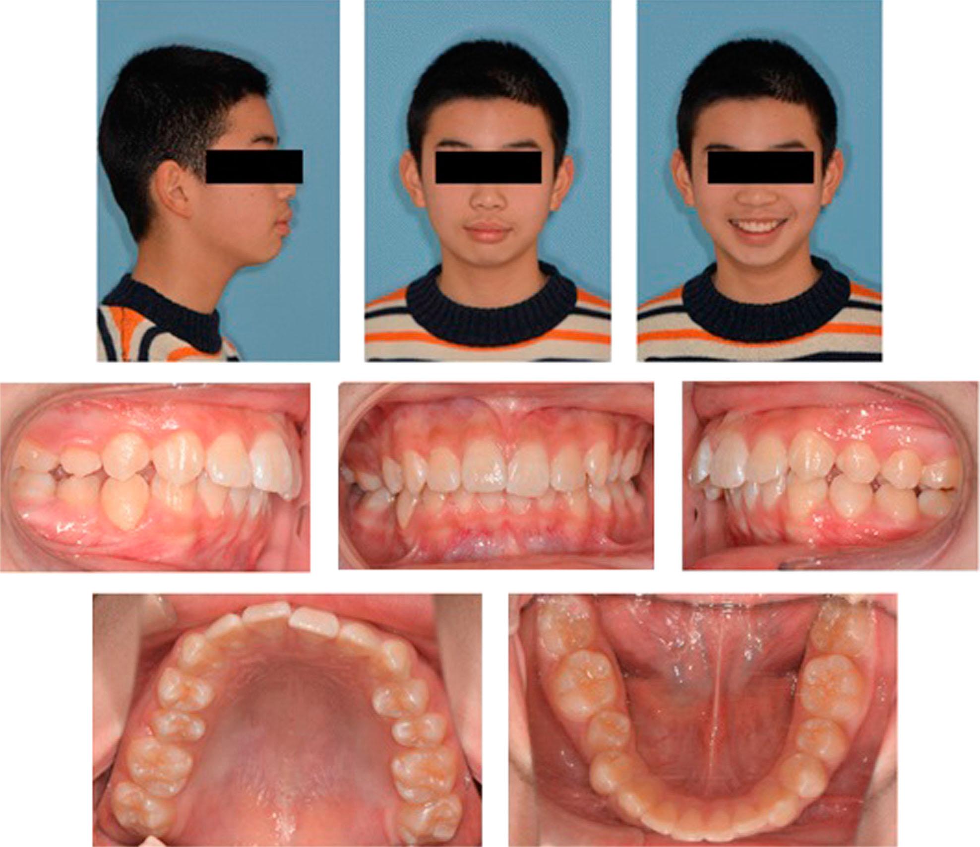 Pretreatment extraoral and intraoral photographs showing the convex profile and Class II molar relation.