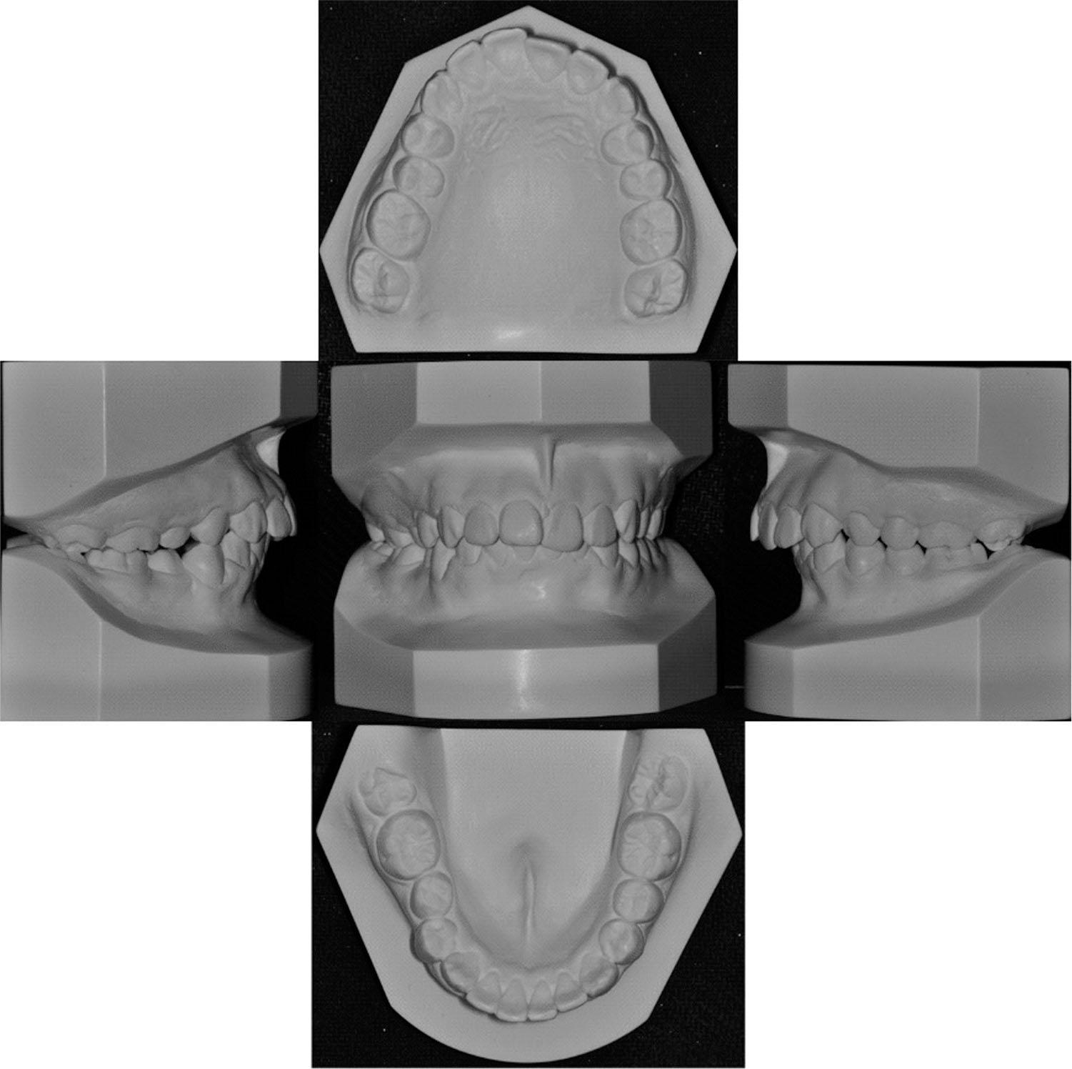 Model scanning photos of pretreatment.