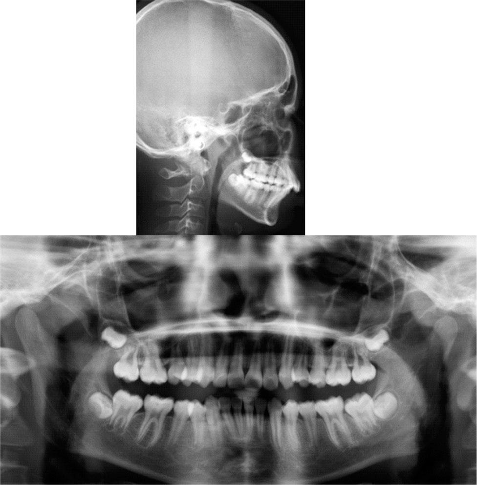 Pretreatment cephalogram and panoramic radiograph.
