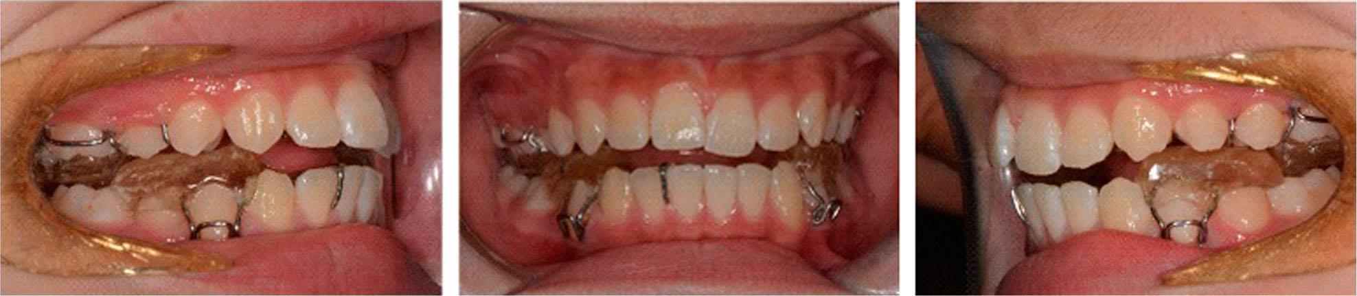 Intraoral display of Twin-block appliance.