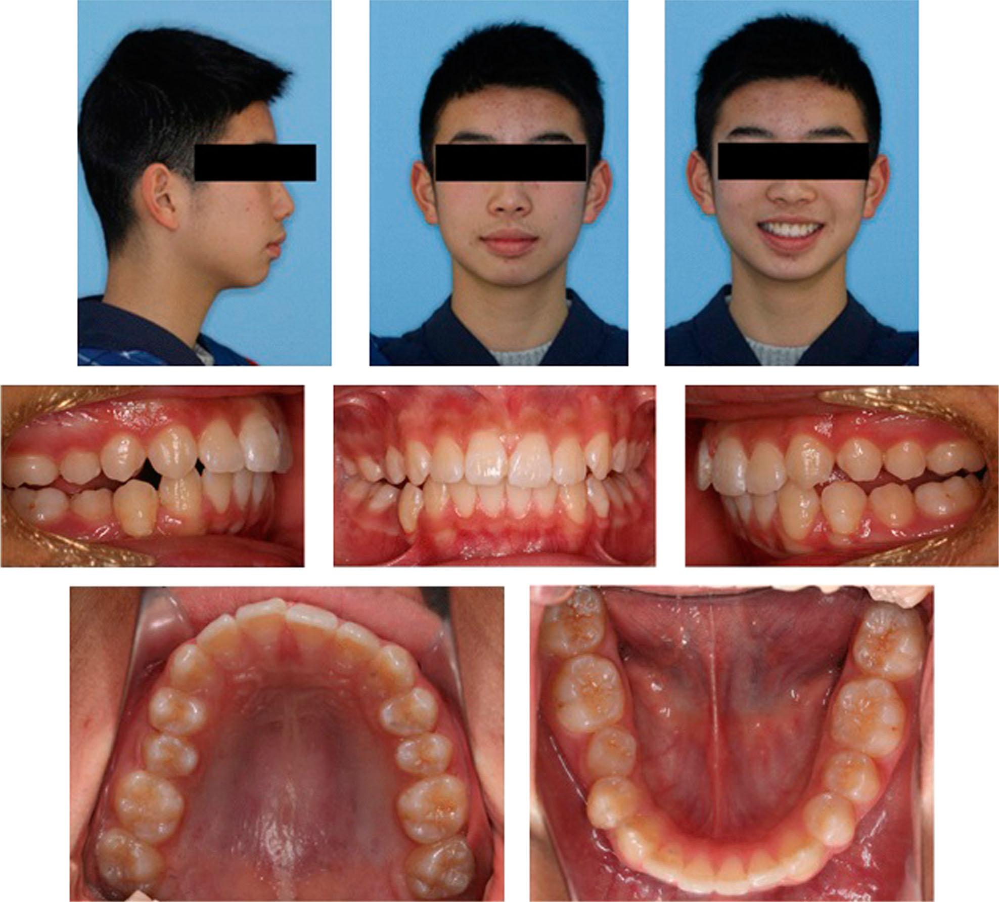 Facial appearance and intraoral photos of patients after functional correction.