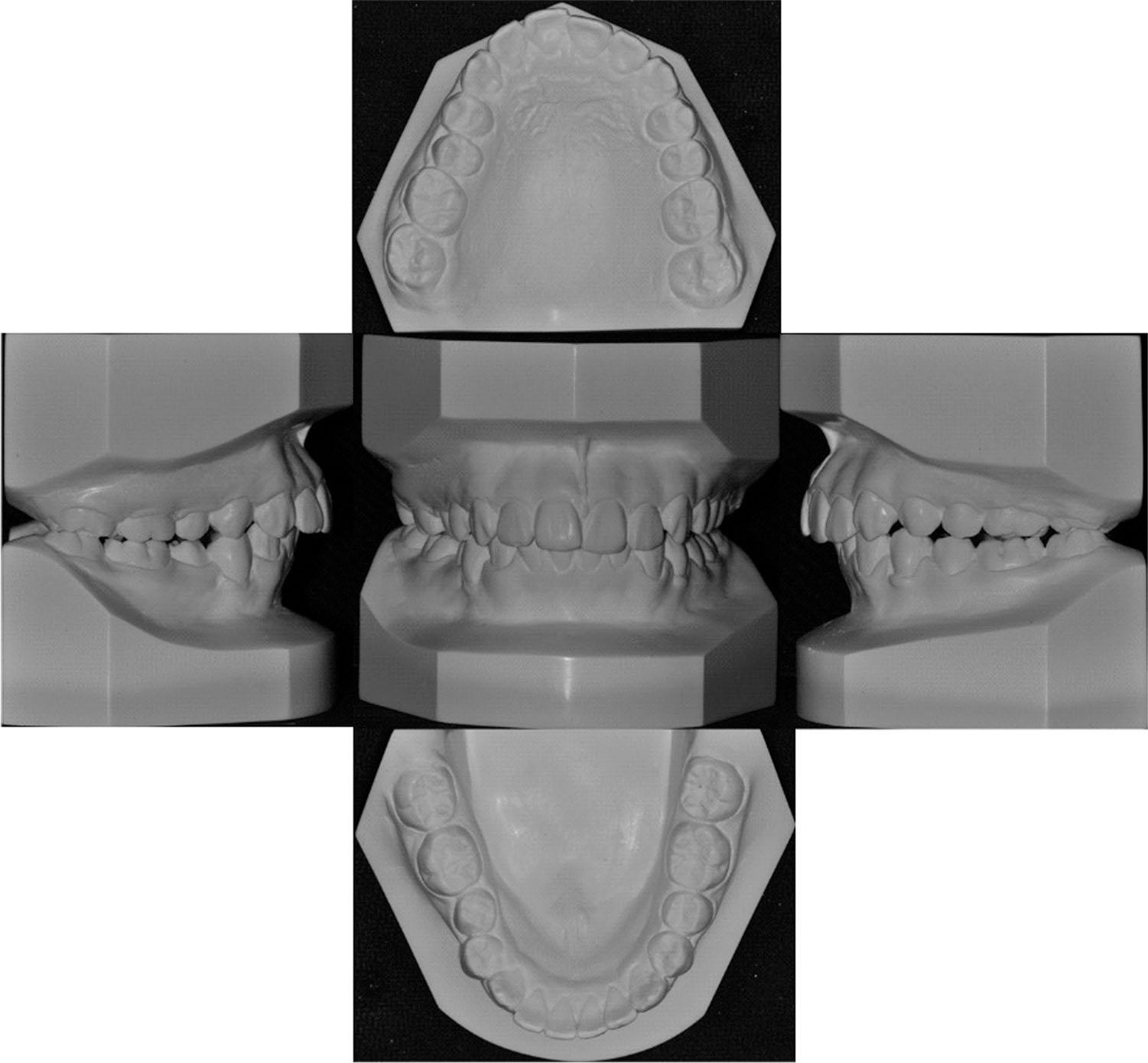 Model scanning photos of 12 months after Twin-block treatment.