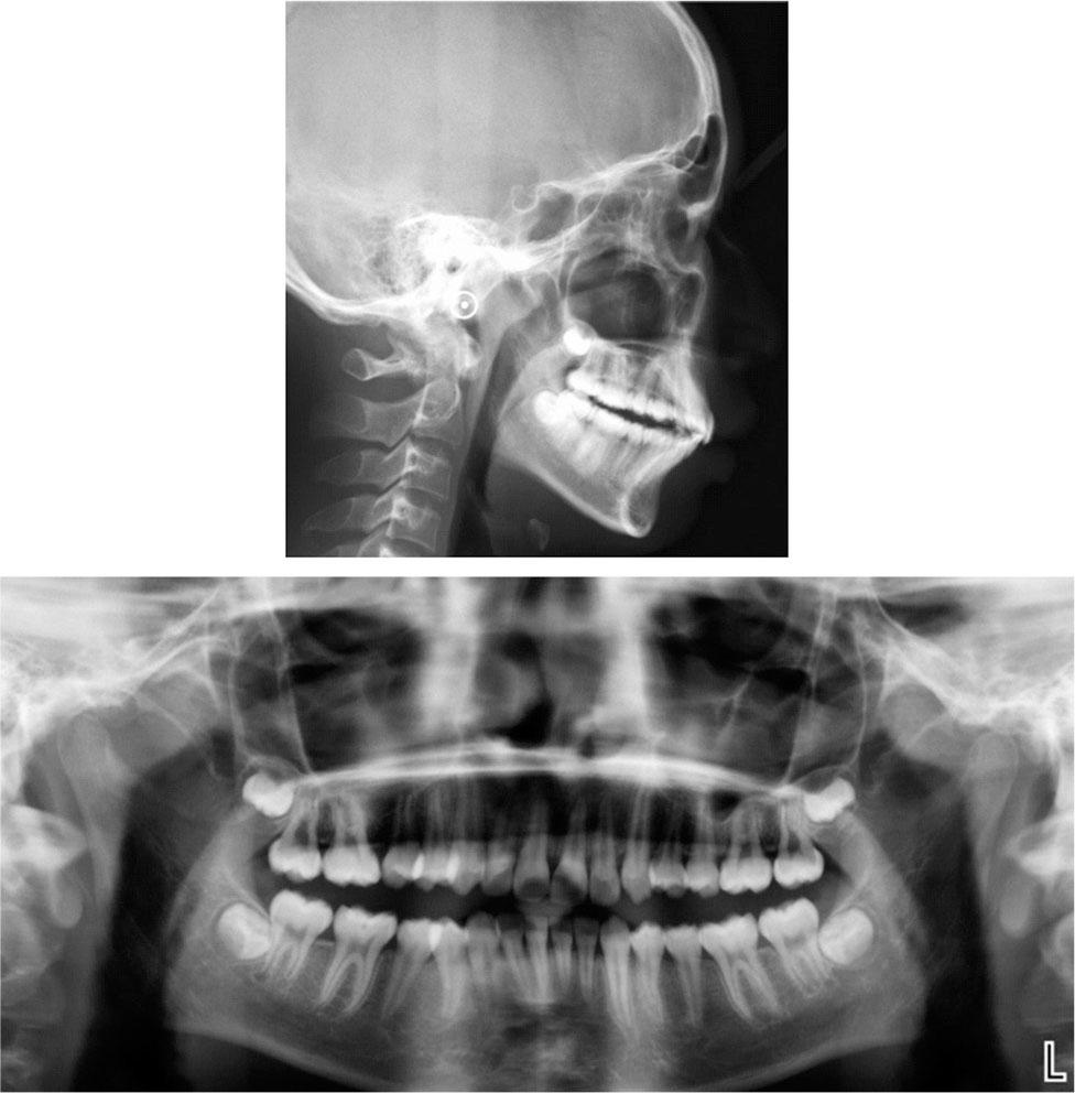 Posttreatment cephalogram, cephalometric superimpositions, and panoramic radiograph.