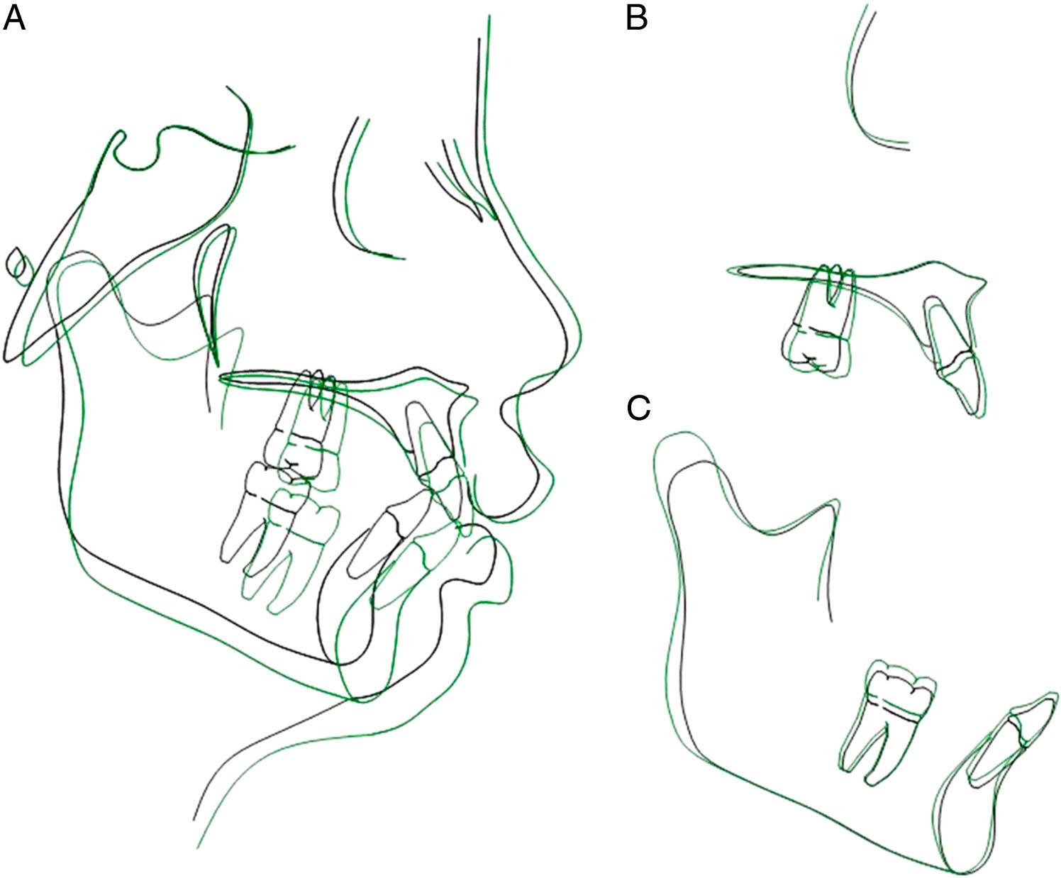 Cephalometric superimpositions after Twin-block treatment. Black line, pretreatment; Green line, after Twin-block treatment. A, The overall super-imposition was registered on SN at sella; B, the maxillary superimposition was registered on the palatal plane at ANS; C, the mandibular super-imposition was registered on the long axis of the mandible at protuberance menti.