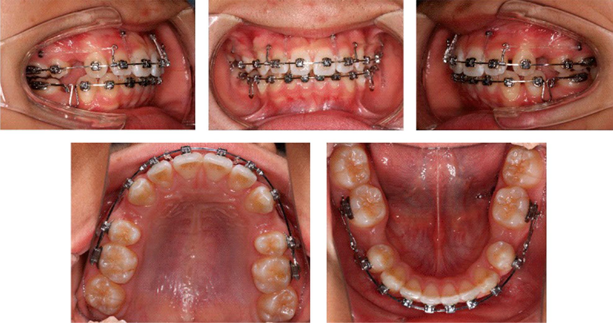 In the 6th month of fixed treatment when the 0.018 × 0.025-in stainless steel archwires were placed in both arches, microimplant anchorages were placed to lower the upper anterior teeth.