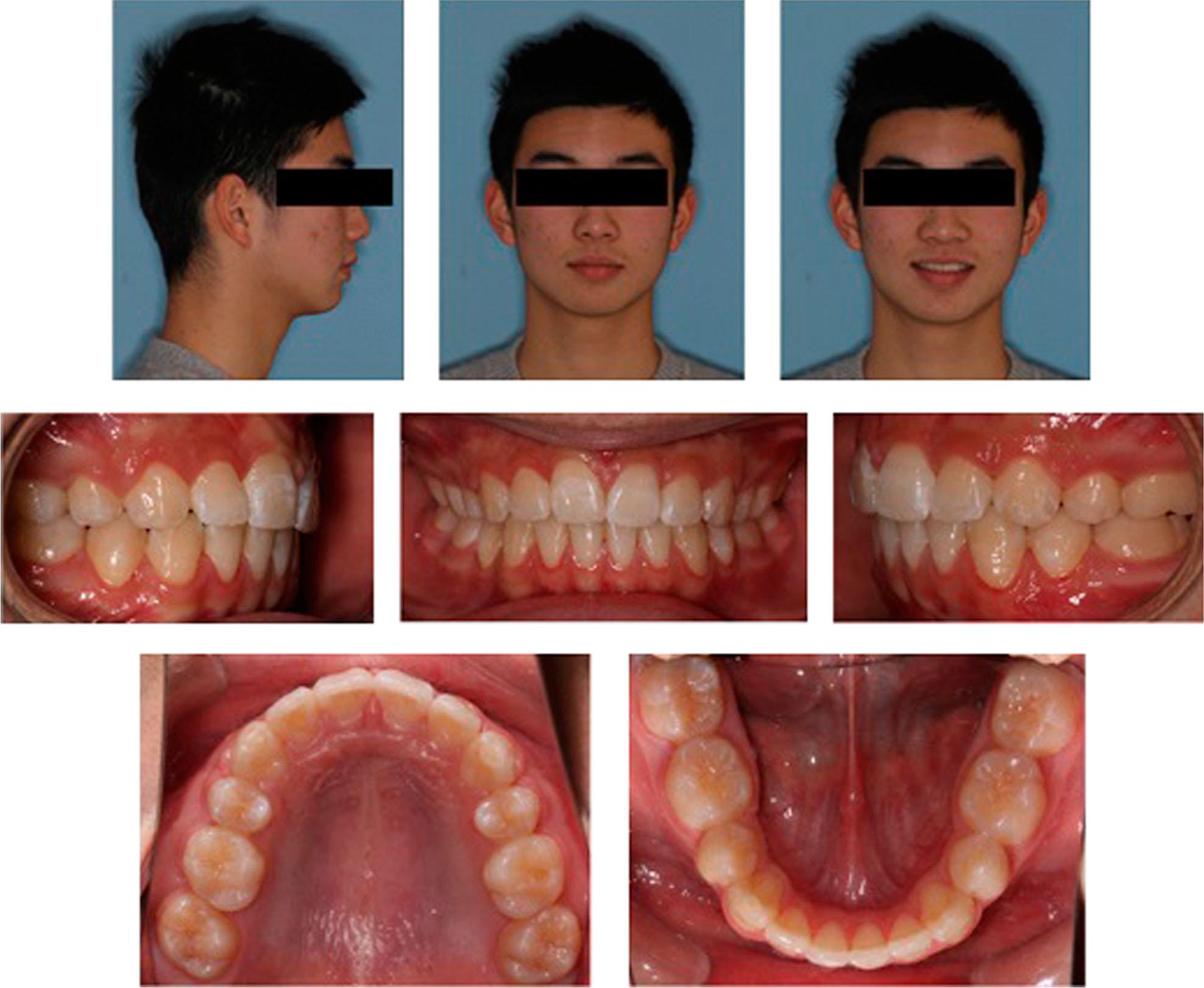 Posttreatment extraoral and intraoral photographs showing the improved facial appearance and molar relationship.