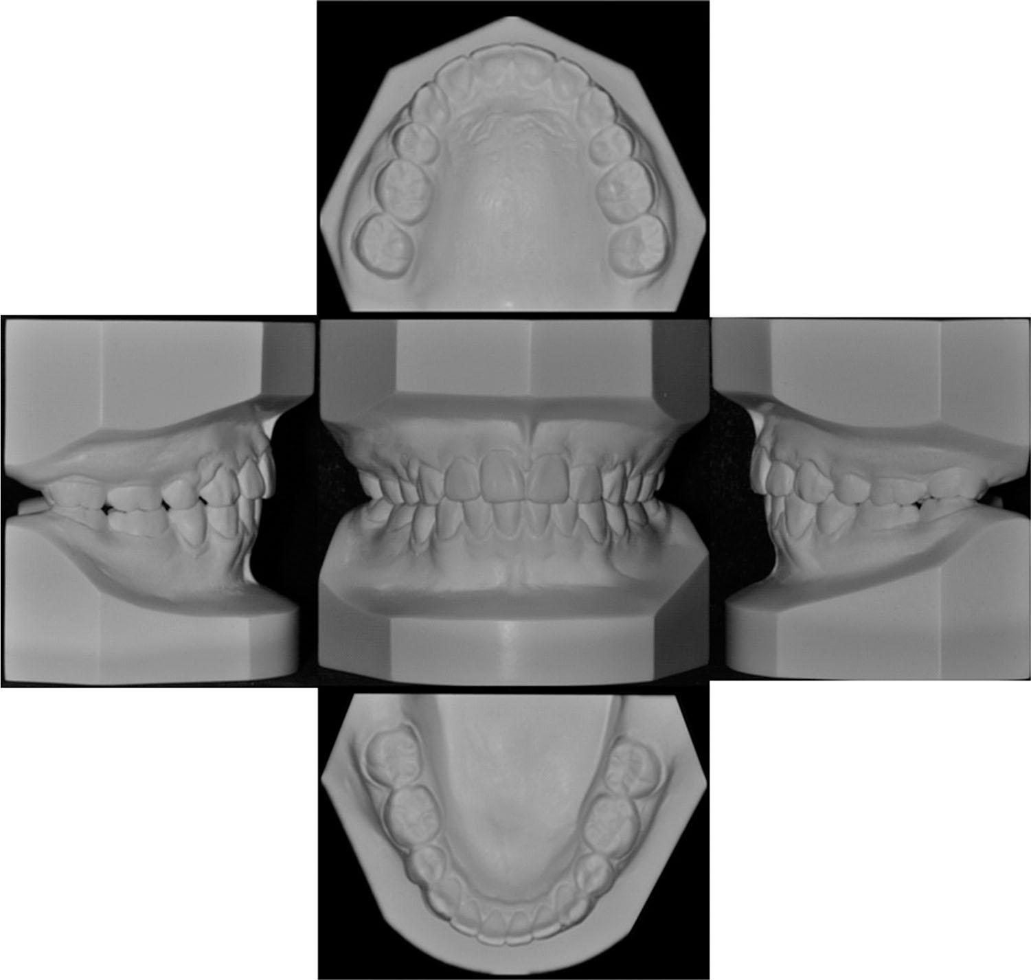Model scanning photos of 36 months after fixed orthodontic treatment.