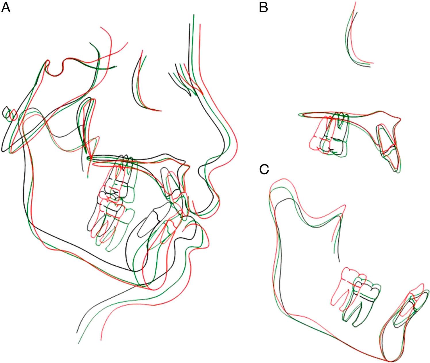 Posttreatment cephalometric superimpositions. Black line, pretreatment; Green line, after Twin-block treatment; Red line, posttreatment. A, The overall superimposition was registered on SN at sella; B, the maxillary superimposition was registered on the palatal plane at ANS; C, the mandibular super-imposition was registered on the long axis of the mandible at protuberance menti.