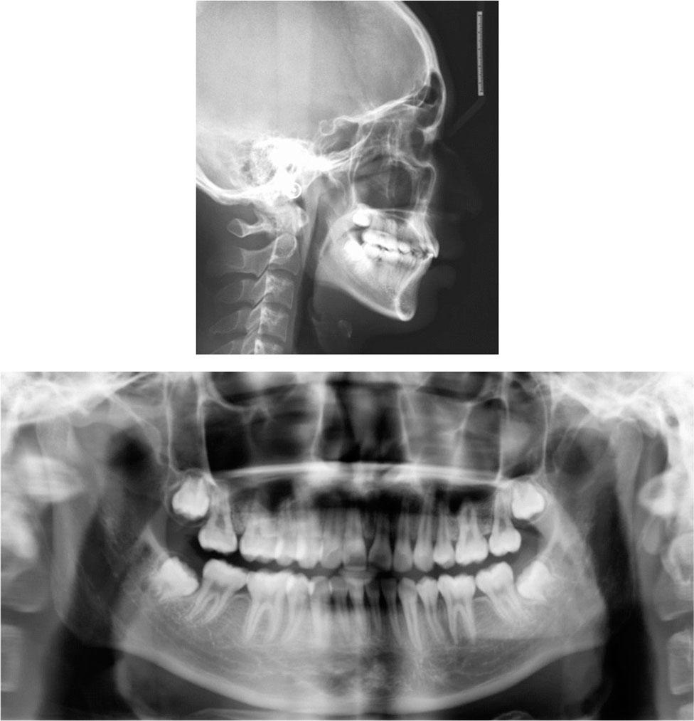 Posttreatment cephalogram and panoramic radiograph.