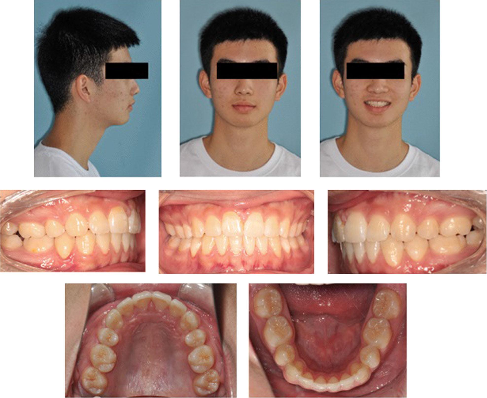 Follow-up after 2 years of retention.