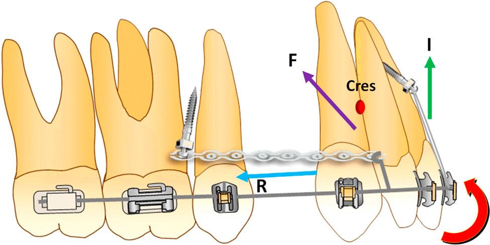 Biomechanical design for closing the space, where I=intrusive force, R=distal force, F=resultant force and Cres=Centre of resistance of the an-terior teeth, the anterior mini-screws and elastics can give the stainless steel rectangular wire an upward force and positive torque, the posterior mini-screws and power arm can achieve body movement of the anterior teeth, the red curve represents counterclockwise rotation of maxillary anterior teeth.