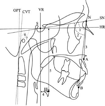 Linear and angular measurements. 1. SNA; 2. SNB; 3. ANB; 4. Hi-VR; 5. Hi-HR; 6. SN-OPT; 7. SN-CVT.