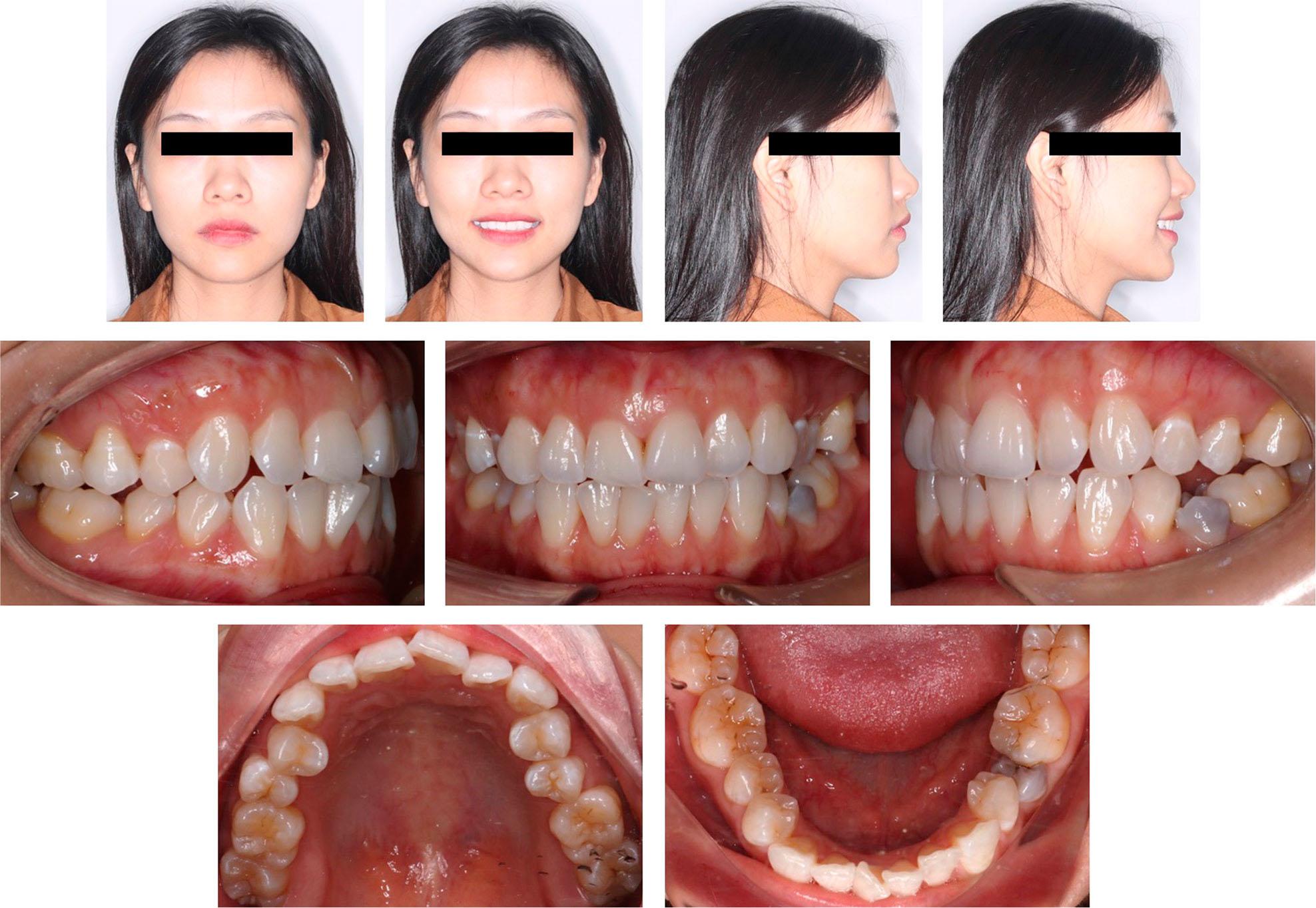 Pretreatment facial and intraoral photographs.