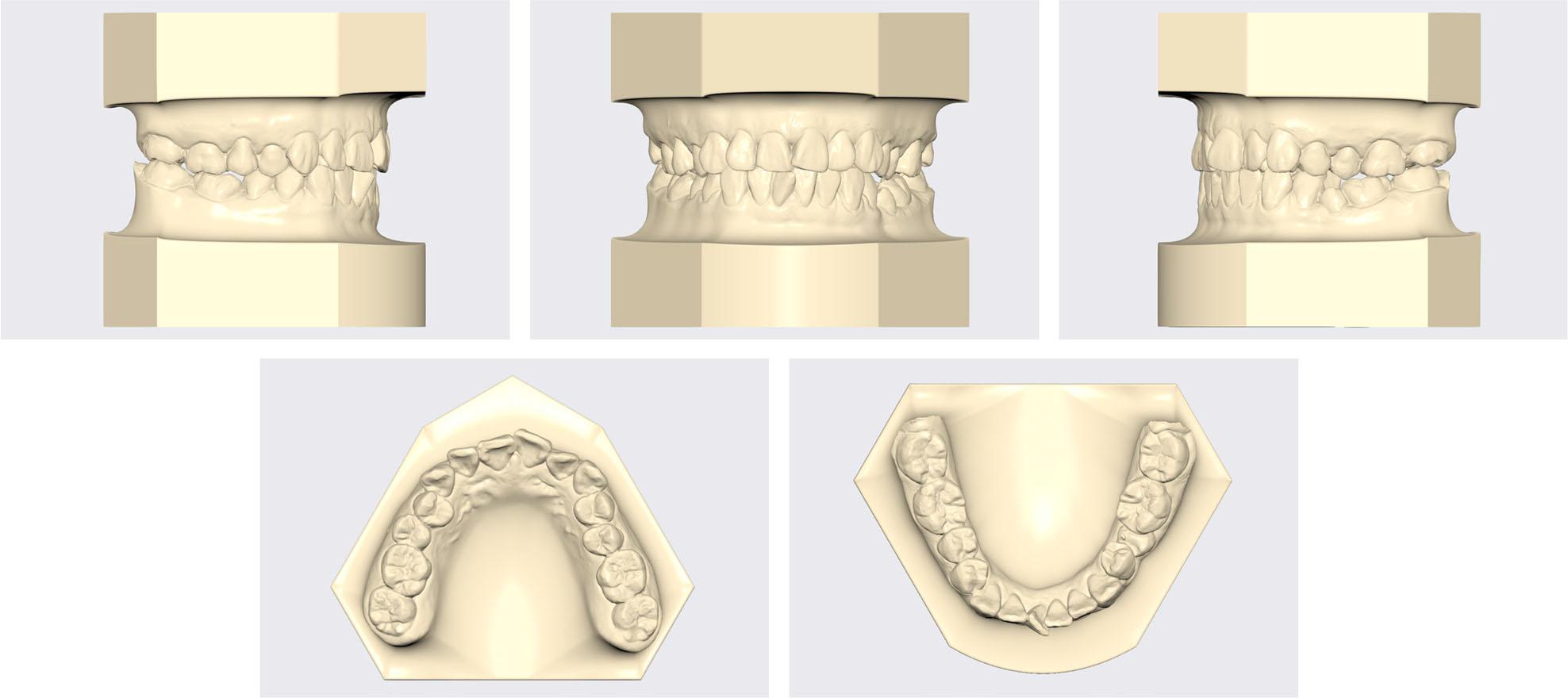 Pretreatment models.