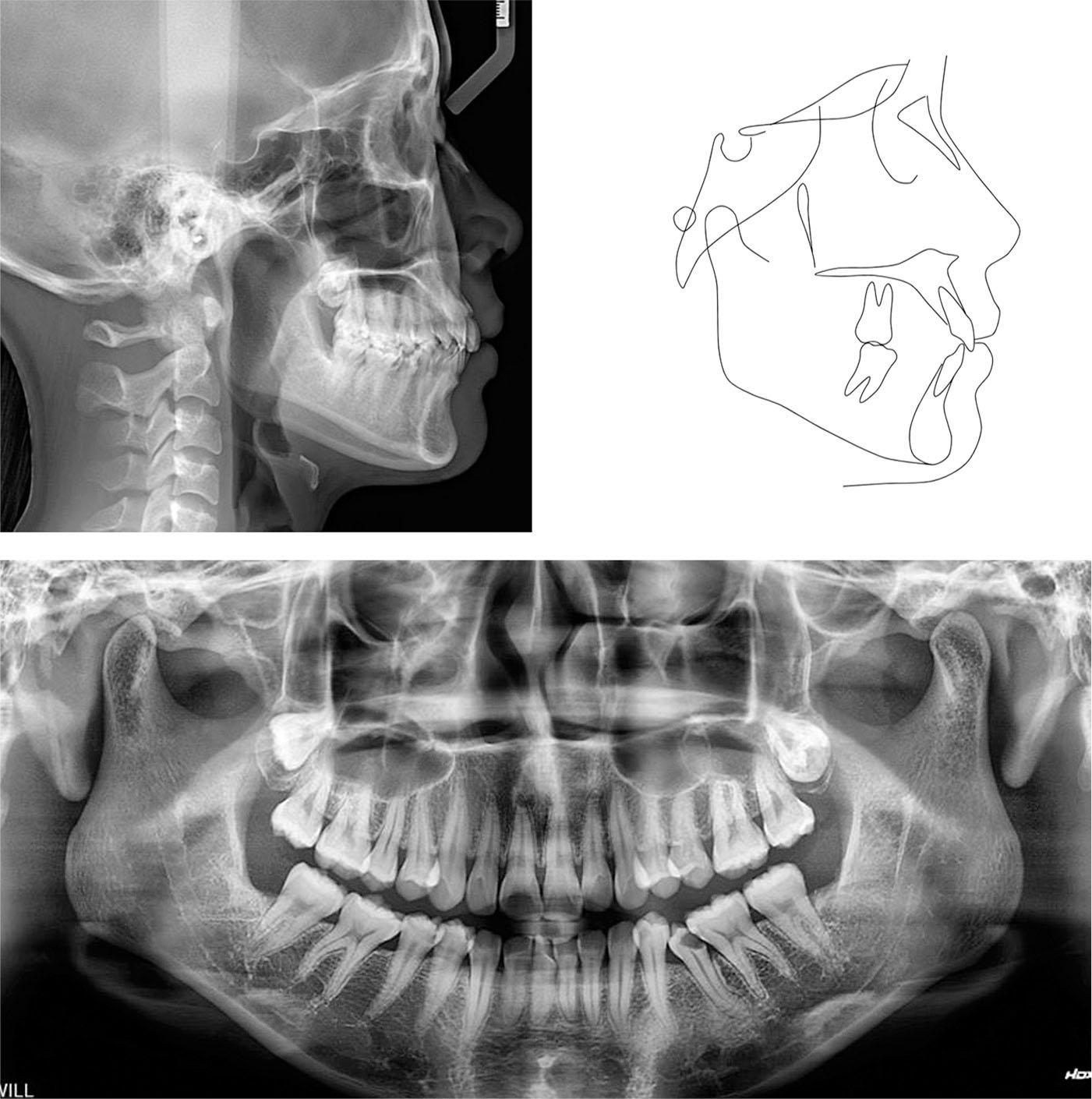 Pretreatment radiographs and tracing.