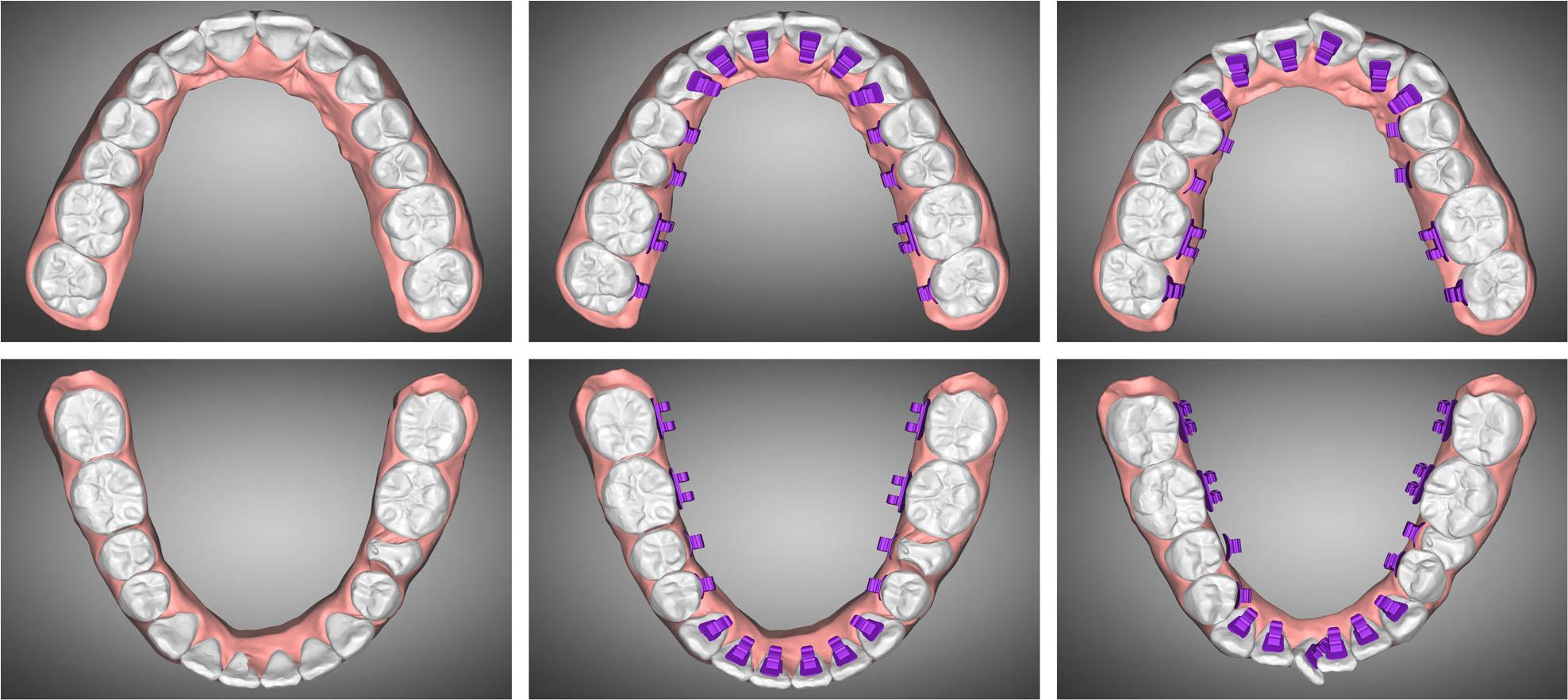 Orthodontic setup and virtual bracket placement.