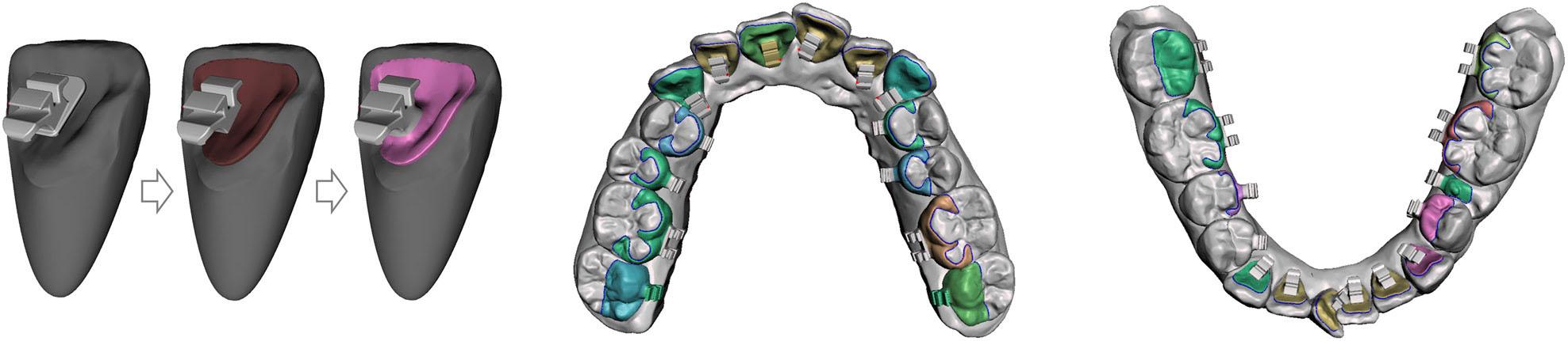 Customised lingual bracket design.