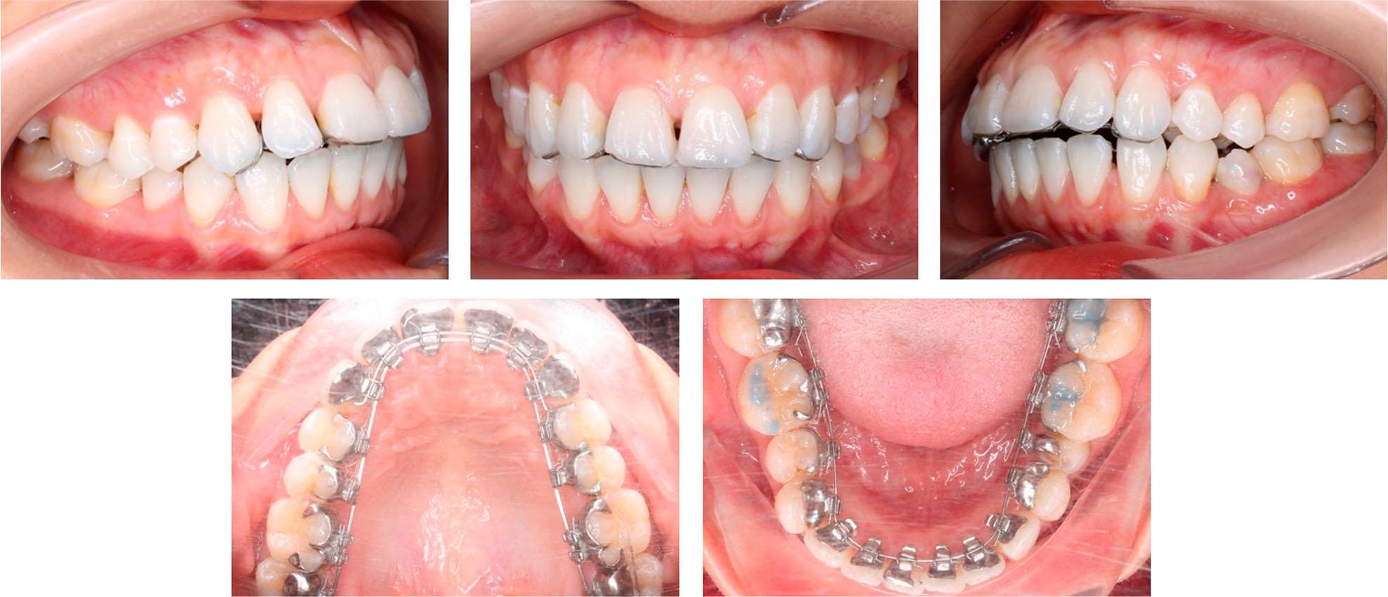 Upper incisor proclination and increased overjet after the levelling and alignment stage.