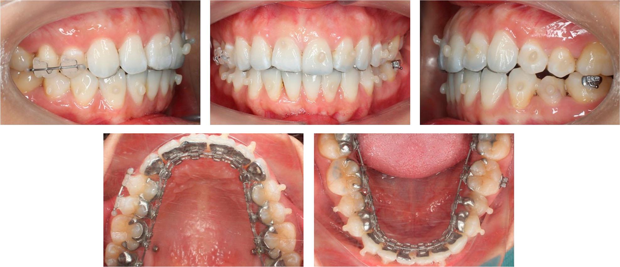 Finishing stage with composite buttons for applying vertical settling elastics.