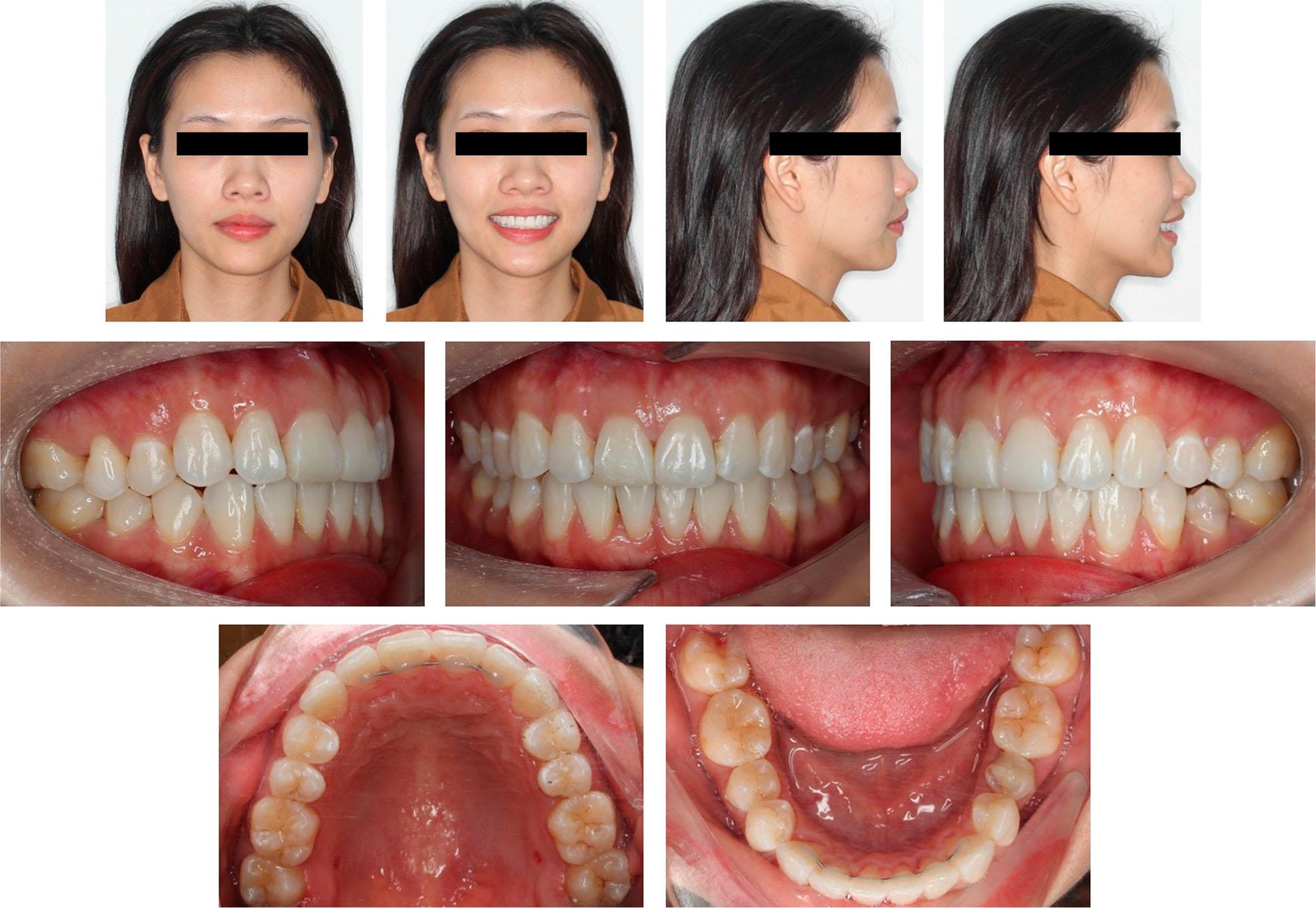 Post-treatment facial and intraoral photographs.