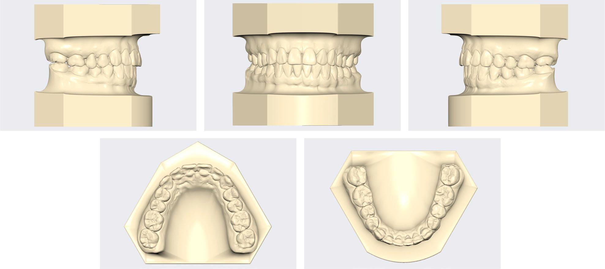 Post-treatment models.