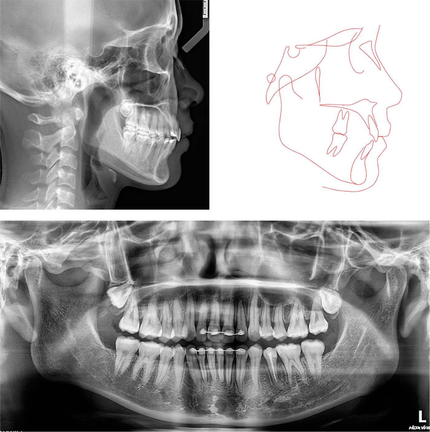 Post-treatment radiographs and tracing.
