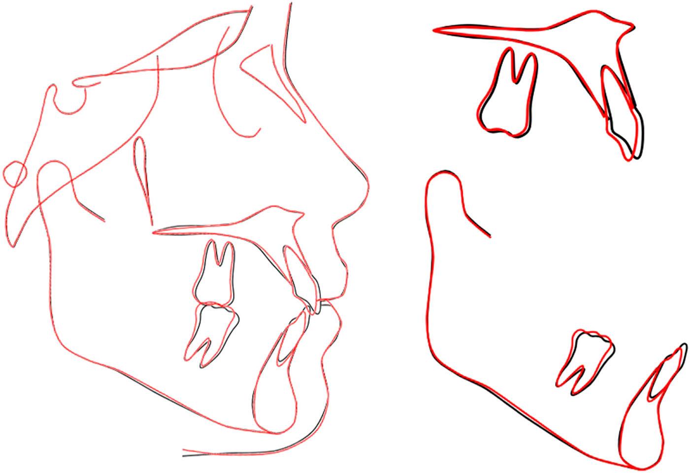 Overall and regional cephalometric superimpositions of the initial (black) and final (red) lateral cephalometric tracings.