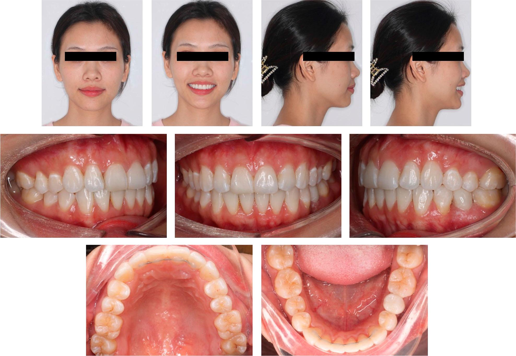 One-year retention photographs.