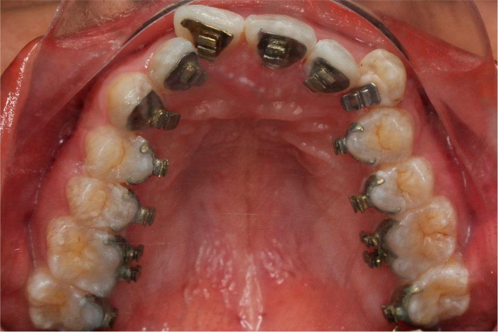 Titanium bracket color variation by anodising.