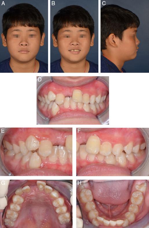 (A–C) Pretreatment extra-oral photographs. (D—H) Pretreatment intra-oral photographs.