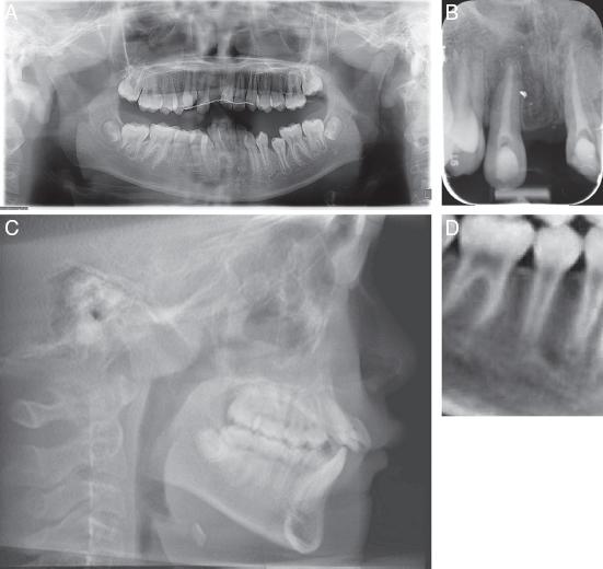 (A) Pretreatment dental panoramic radiograph. (B) Periapical radiograph showing resorption on the apical surfaces of #12 and #21. (C) Lateral cephalogram. (D) CBCT section showing developing tooth #45 with ¾ root length.