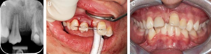 (A) Periapical radiograph taken 2 weeks post-autotransplantation. (B)Transplanted tooth secured with a flexible wire splint. (C) Composite build-up of the transplanted tooth 1-month post-autotransplantation.
