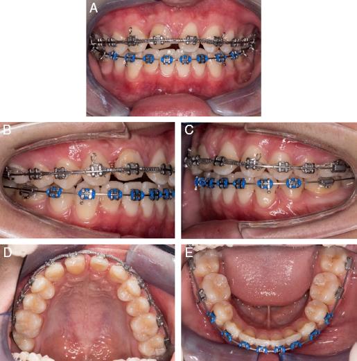 (A–E) Midtreatment intra-oral photographs.
