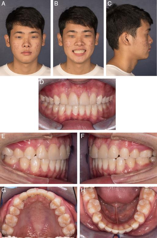 (A-C) Posttreatment extra-oral photographs. (D-G) Posttreatment intra-oral photographs.