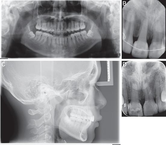 (A) Posttreatment panoramic radiograph. (B) Periapical radiograph of transplanted tooth showing good root length and pulp canal obliteration. (C) Lateral cephalogram. (D) 4-year follow-up of the transplanted tooth #45 showed blunting of the root apex and a localized concavity on the mesial aspect of the root. The tooth should be reviewed in the longer term to assess for any developing signs of root resorption.