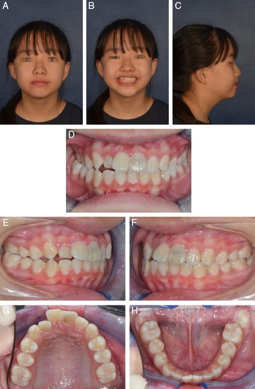 (A-C) Pretreatment extra-oral photographs. (D-H) Pretreatment intra-oral photographs.