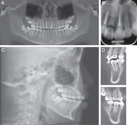 (A) Pretreatment panoramic radiograph. (B) Periapical radiograph showing decoronated #11 and crown attached; Resorption on the apical surfaces of #12 and #21. (C) Lateral cephalogram. (D) CBCT section showing developing tooth #35 with ⅔ root length and (E) Developing tooth #45 with ¾ root length.