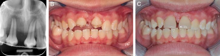 (A) Periapical radiograph taken 1 week post-autotransplantation; teeth #35 and #45 secured with a flexible wire splint. (B) Lower second premolars transplanted into the anterior maxilla region. (C) Composite build-up 2 months post-autrotransplantation.