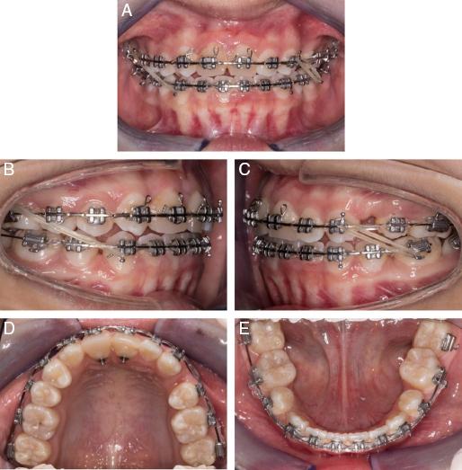 (A-E) Midtreatment intra-oral photographs.