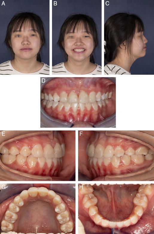 (A-C) Posttreatment extra-oral photographs. (D-H) Posttreatment intra-oral photographs.