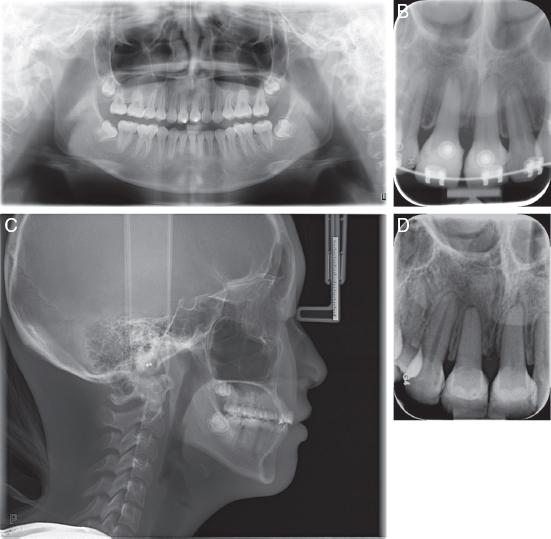 (A) Posttreatment panoramic radiograph. (B) Periapical radiograph of autotransplanted teeth showing good root length and pulp canal obliteration. (C) Lateral cephalogram. (D) 4-year follow-up of the transplanted teeth showing adequate root lengths and optimal intra-crestal bone levels. Pulp canal obliteration was seen in both transplanted teeth.