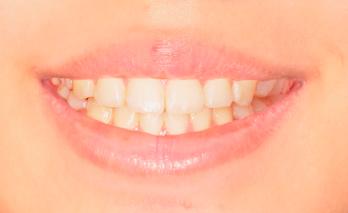 Smile with -4 mm gingival display.