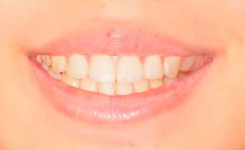Smile with -2 mm gingival display.