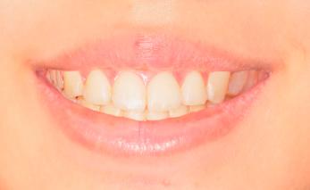 Smile with 0 mm gingival display.