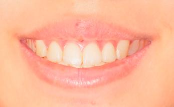 Smile with +2 mm gingival display.