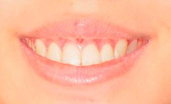 Smile with +4 mm gingival display.