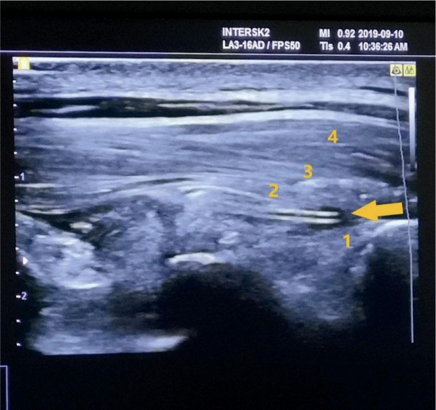Ultrasound image of the inserted ESPB catheter (marked by an arrow) and interfascial hydro-dissection.1 – underlying thoracic lamina, 2 – m. erector spinae, 3 – m. rhomboideus, 4 – m. trapezius